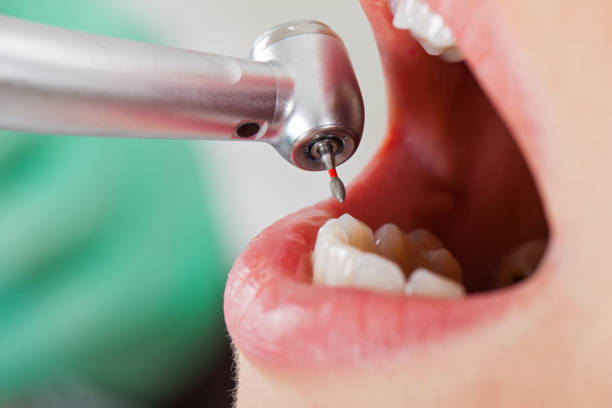 Best Emergency Dentist for Lost Fillings or Crowns in Shallotte, NC